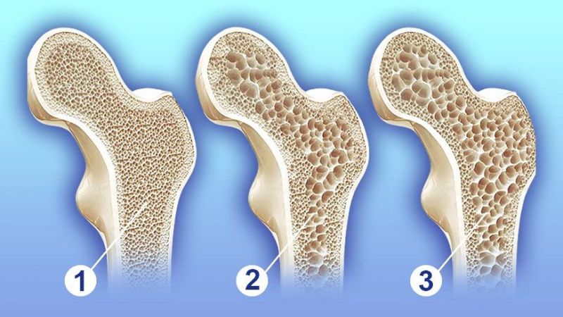 Kemik Erimesine Karşı Doğal Besinle Çözüm Bulundu! Bilim İnsanları Tavsiye Etti: Her Gün Tüketin! 1