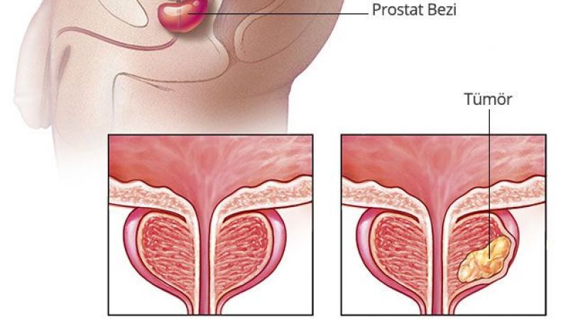En Sık Ölüme Neden Olan Hastalıklar Arasında Bulunuyor ve Çok Fazla Yanlış Bilgi İçeriyor! Uzman İsim Açıkladı: Bunlara Gerek Yok… 3