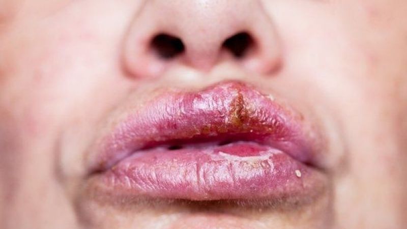 Kanser Tedavisinde Devrim! Uçuk Virüsü Kullanılarak Geliştirilen Yöntem İnsanlarda Olumlu Sonuç Verdi! 1