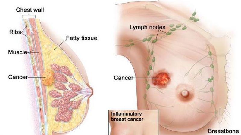 Meme Kanserinde Erken Tanı İçin Yeni Sistem Devrede; Kanser Randevu Sistemi, Artık Tüm Türkiye’de! Üstelik Randevuları Aile Hekimliği Verecek… 2