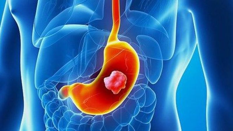 Bu Gıdaları Sofranıza Her Gün Almayın! Mide Kanserinden Korunmak İçin Mutlaka Okuyun! Sağlıklı Sandığınız Gıdalar Bile Listede… 2