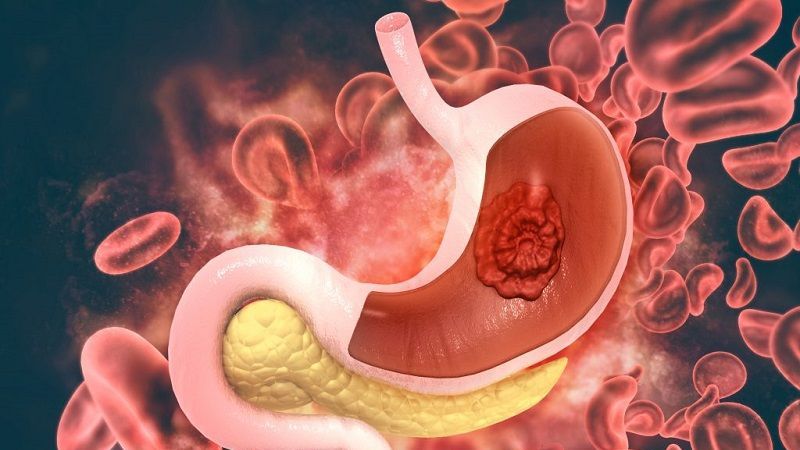 Bu Gıdaları Sofranıza Her Gün Almayın! Mide Kanserinden Korunmak İçin Mutlaka Okuyun! Sağlıklı Sandığınız Gıdalar Bile Listede… 1