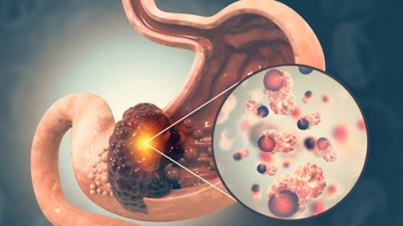 Bu Gıdaları Sofranıza Her Gün Almayın! Mide Kanserinden Korunmak İçin Mutlaka Okuyun! Sağlıklı Sandığınız Gıdalar Bile Listede… 4