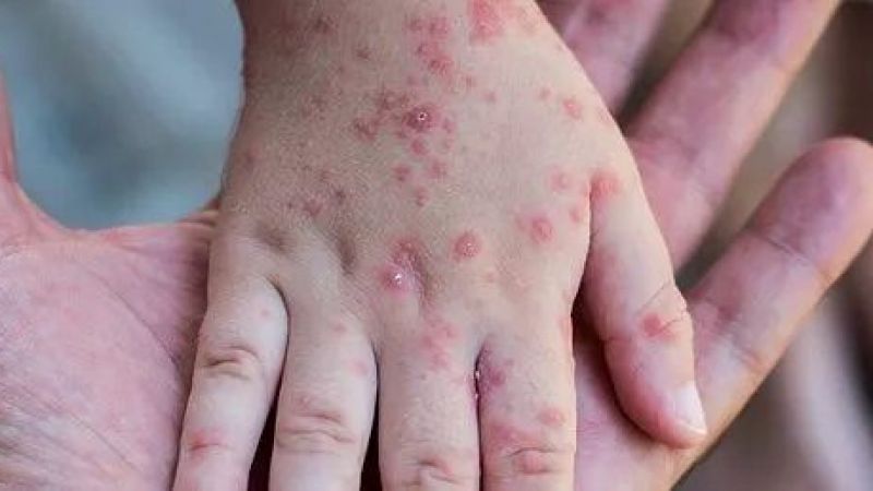 Çocukları Olan Vatandaşların Dikkatine! Dünya Sağlık Örgütü Resmen Uyardı: Kızamık Salgını Geri Geldi! Ölüm Oranları Arttı! 2