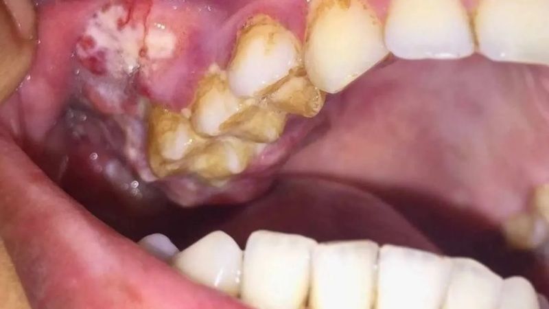 Uzmanlar Uyardı! Az Rastlanan Ağız Kanseri Belirtilerini Fark Ederek Hayatınızı Kurtarabilirsiniz! Ağız Kanseri Nedir, Belirtileri Nelerdir? 2