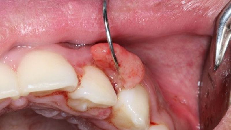 Uzmanlar Uyardı! Az Rastlanan Ağız Kanseri Belirtilerini Fark Ederek Hayatınızı Kurtarabilirsiniz! Ağız Kanseri Nedir, Belirtileri Nelerdir? 3