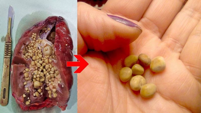 Vücuda Verdiği Zararlar Bitmek Bilmiyor! Böbrek Taşına Sebep Olan O Yiyecekler! 4