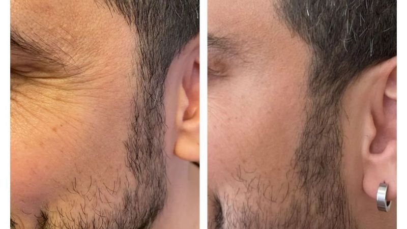 Bu Meyve Sizi Masraftan Kurtaracak! Siz de Evde Doğal Botoks Yapabilirsiniz! Yüz Çizgilerine Son! 1