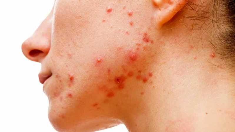 İbn-i Sina’nın mucize reçetesi! Bu besin ile sivilcelerden kurtulun! 1