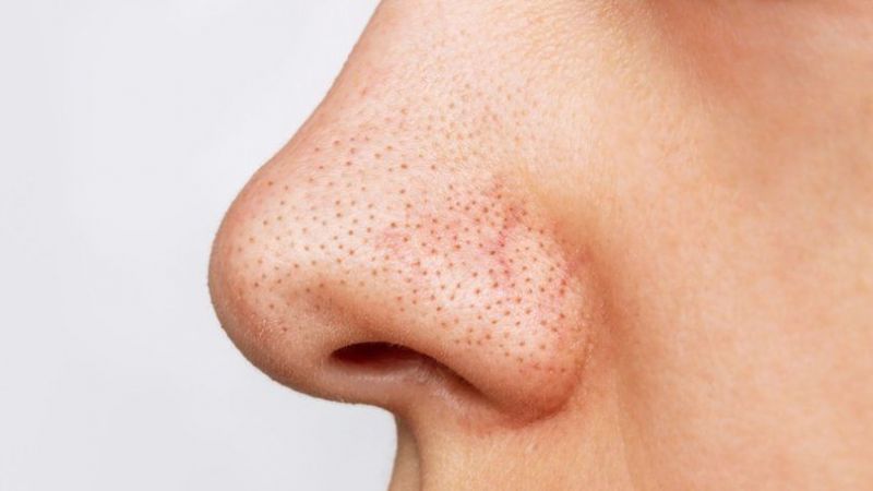 Kadınların Korkulu Rüyası: Siyah Noktalardan Bu Yöntemler İle Kurtulun! 2