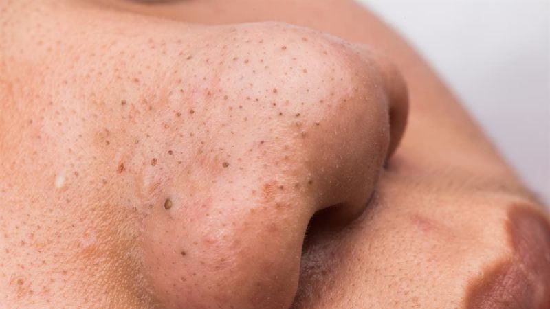 Kadınların Korkulu Rüyası: Siyah Noktalardan Bu Yöntemler İle Kurtulun! 1