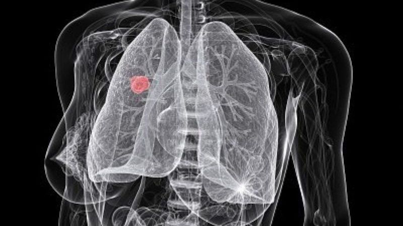 Yüksek Riskli Kanser Hastaları Erken Tespit Edilecek! Yapay Zekâ Modellemesi Nasıl Çalışıyor? 1