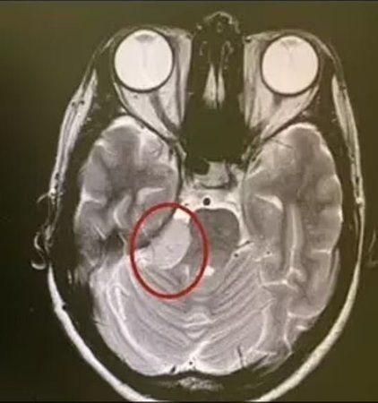 10 Sene Gizlice Büyüyen Tümörle Yaşadı! Elektrik Çarpması Gibi Bir Hisle Uyanınca… 2
