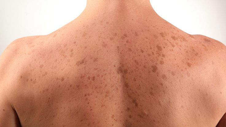 Cildiniz Diyabet İçin Risk Taşıyor Olabilir! Ciltte Meydana Gelen Bu Değişimi Ciddiye Alın! 1