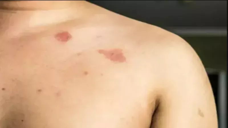 Cildiniz Diyabet İçin Risk Taşıyor Olabilir! Ciltte Meydana Gelen Bu Değişimi Ciddiye Alın! 2