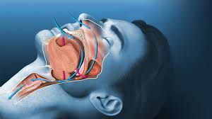 Uyurken Horlayanların Daha Çok Alzheimer Olma İhtimali Bulunuyor! Uyku Apnesi Nedir? 1