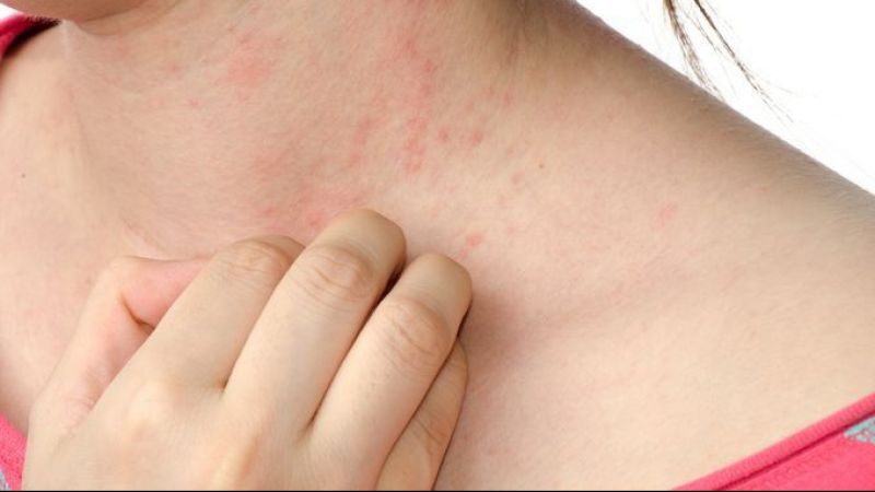 Çilek alerjisi: Yaz aylarının popüler meyvesi, sağlığınızı tehdit edebilir! 3