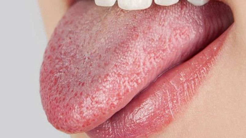 Ağız kuruluğu hastalıklar için erkenden belirti veriyor olabilir! Bu 5 hastalık ağız içinde kuruluk yapıyor! 4