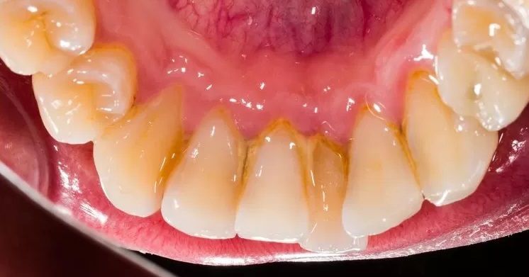 Evde bulunan malzemelerle diş tartarlarını ve plakları bu teknikle yok edin 2