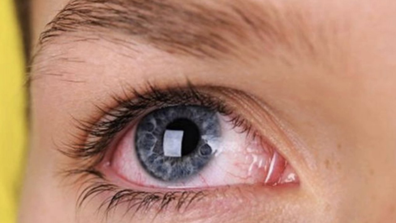 Gözyaşınız akmıyorsa nedeni bağışıklık hastalığı olabilir