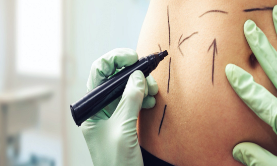 Yağ Hücrelerine Liposuction İle Veda Edin
