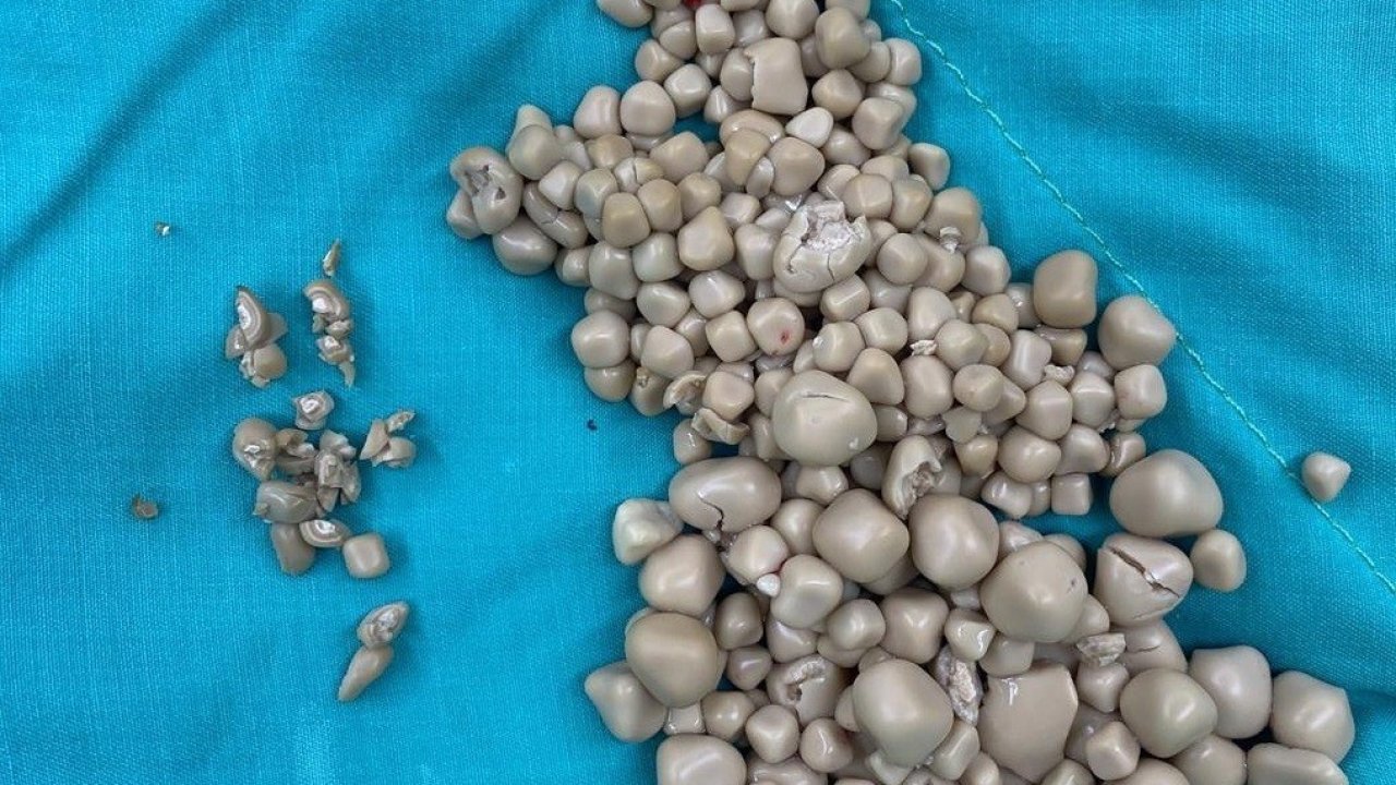 Kadının böbreklerinden 300 taş çıkarıldı