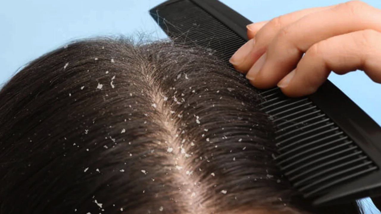 Saç kepeklenmesine Son Veren Yöntem! Doğal Yöntemlerle Kepeklenme Problemine Elveda!