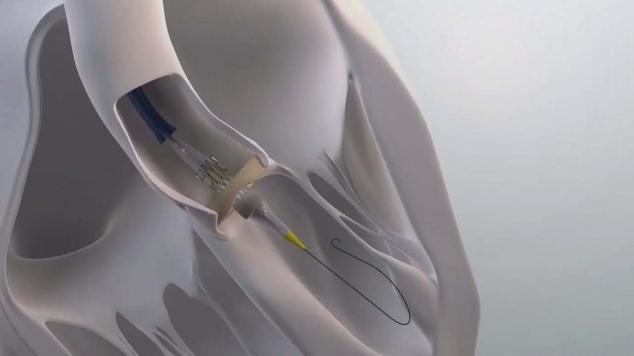 Kalbiniz İçin Yenilikçi Bir Yaklaşım, TAVI