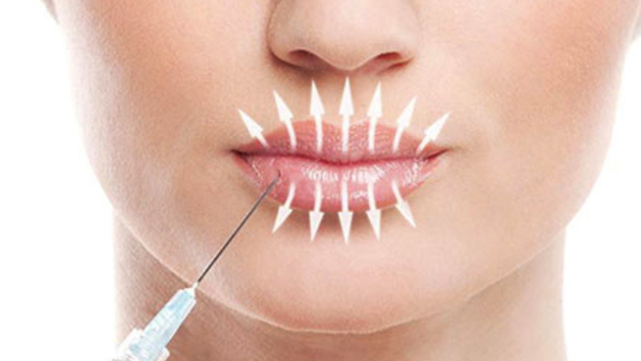 Dudak Dolgusu İle Genç ve Çekici Bir Görünüm!