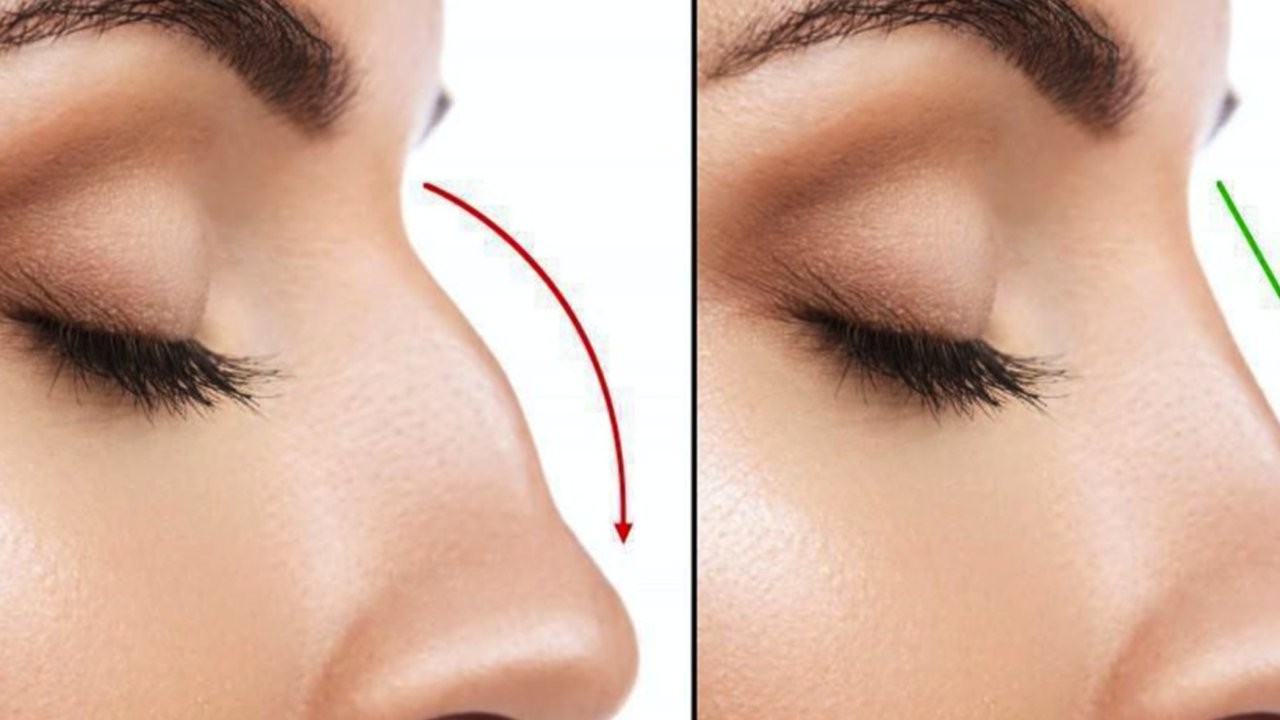 Burun Estetiği ile Hayal Ettiğiniz Buruna Kısa Süre İçerisinde Sahip Olun