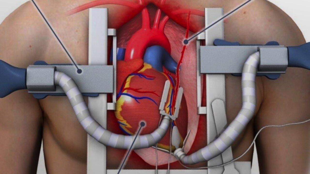 Bypass Ameliyat Riskleri