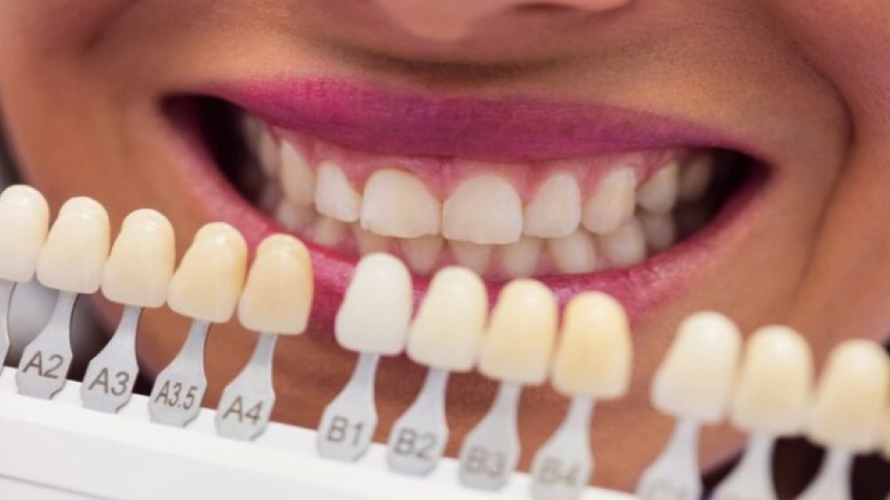 Zirkonyum Diş Kaplama Nasıl Yapılır?