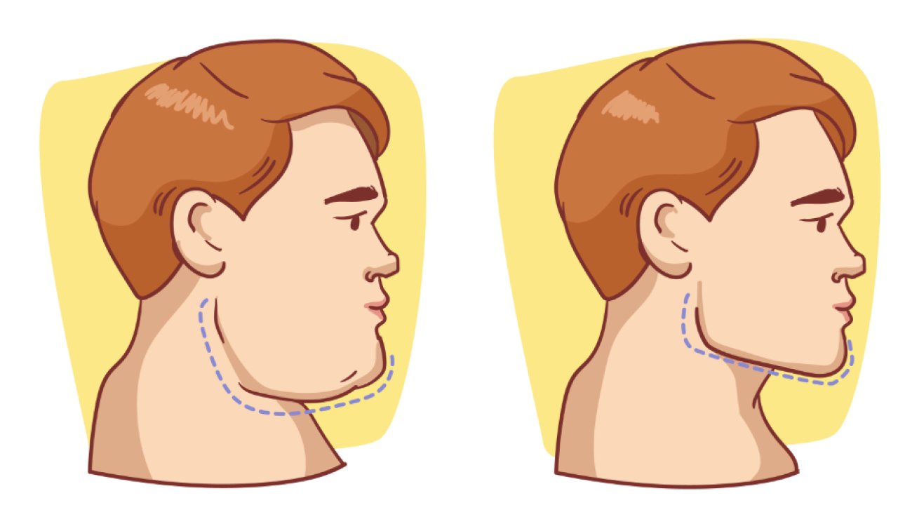 Ortognatik Çene Ameliyatı Nasıl Yapılır?