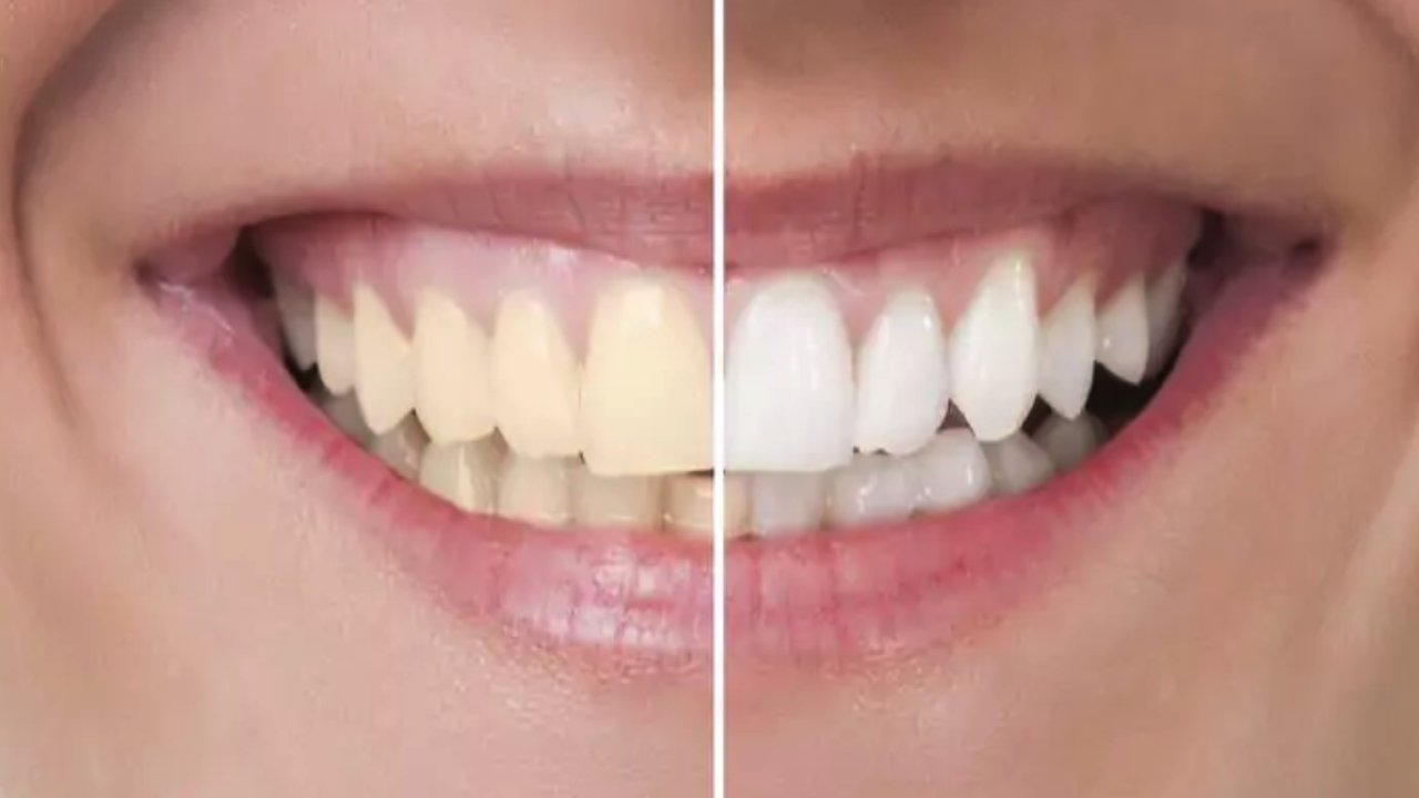 Diş beyazlatma nedir ve nasıl yapılır?