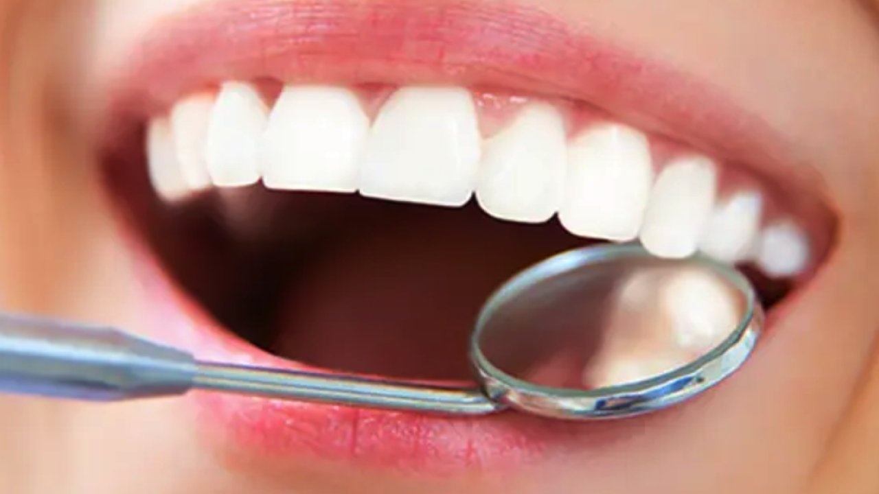 Diş Beyazlatma Nedir ve Nasıl Çalışır?