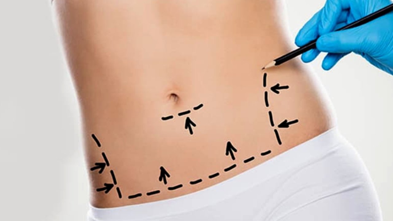 Vaser liposuction nedir ve nasıl çalışır?