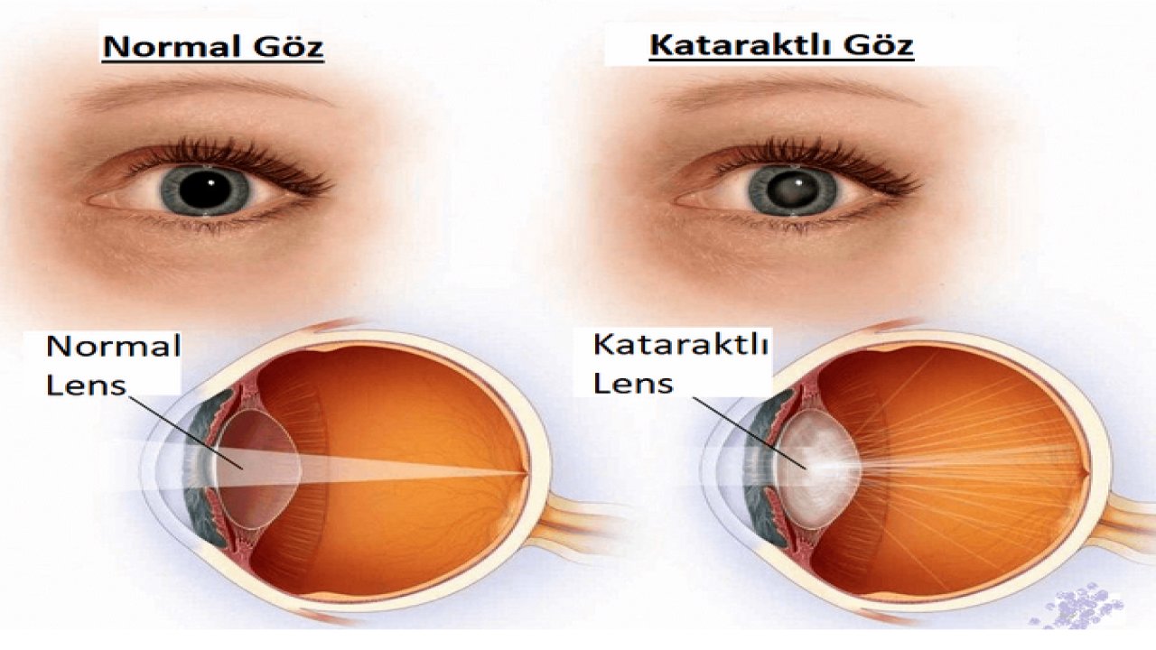 Katarakt ameliyatı nedir ve nasıl yapılır?