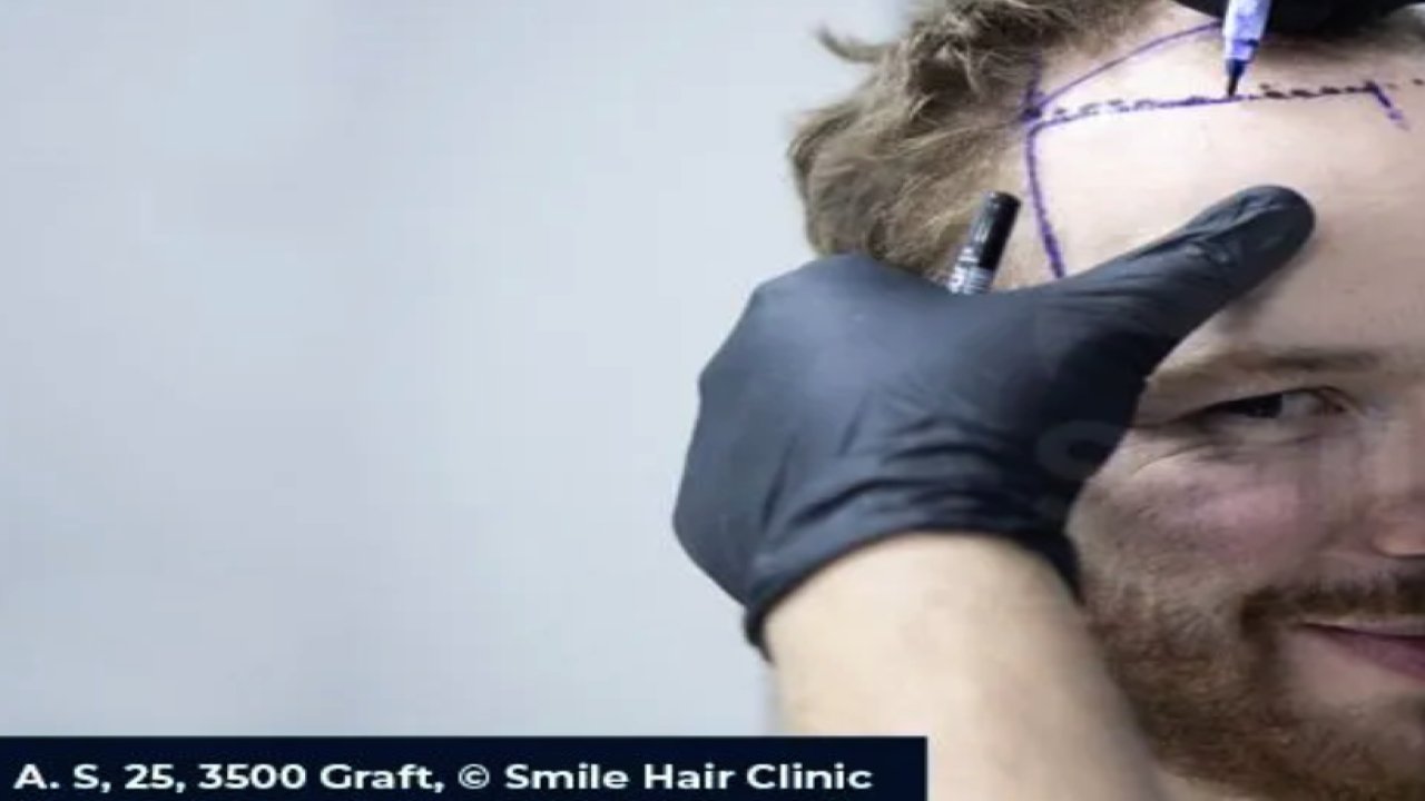 FUE (Foliküler Ünite Ekstraksiyonu)