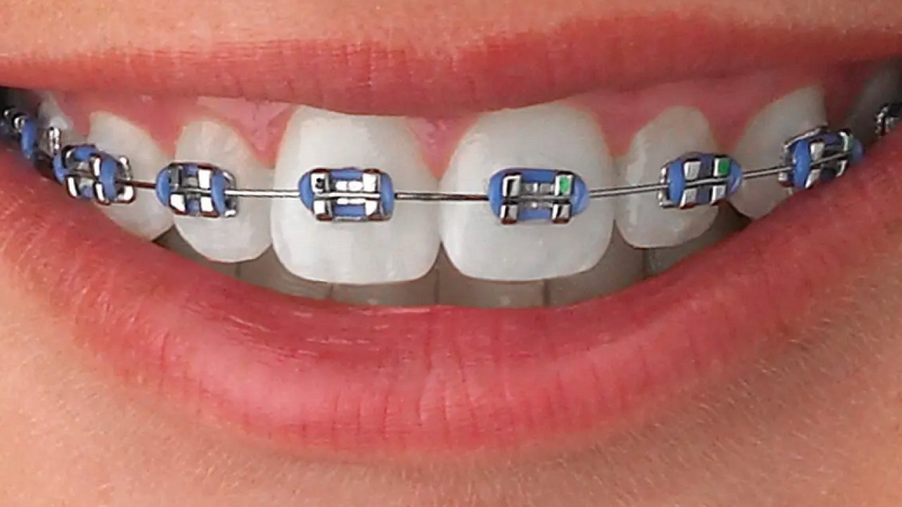 Diş Teli Fiyatları Ne Kadar? Hangi Türler Tercih Edilmeli?