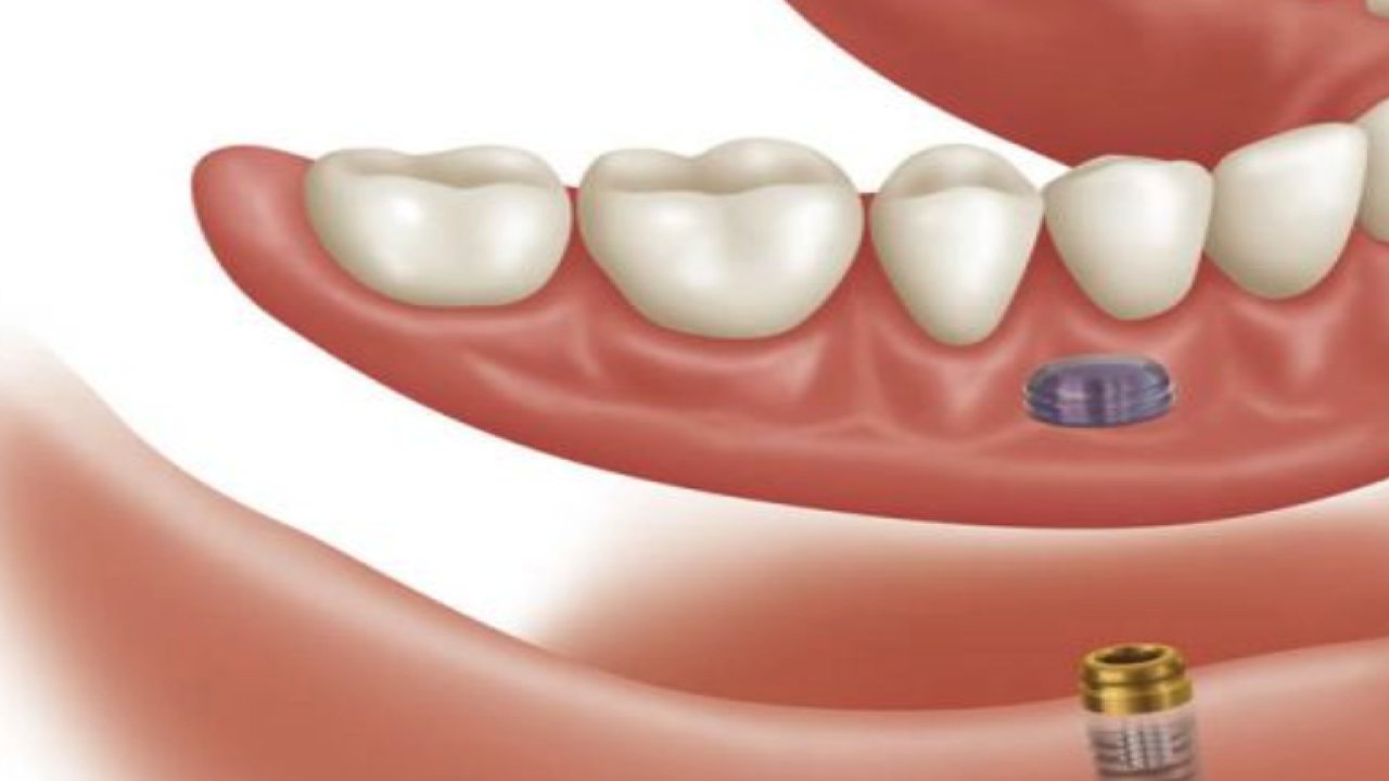 Konya İmplant Fiyatları ve Etkileyen Faktörler
