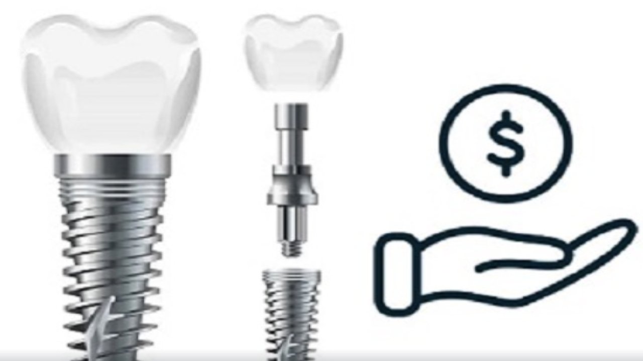 2025 Yılında Güncel İmplant Fiyatları: Sağlıklı Gülüşler İçin Doğru Seçim