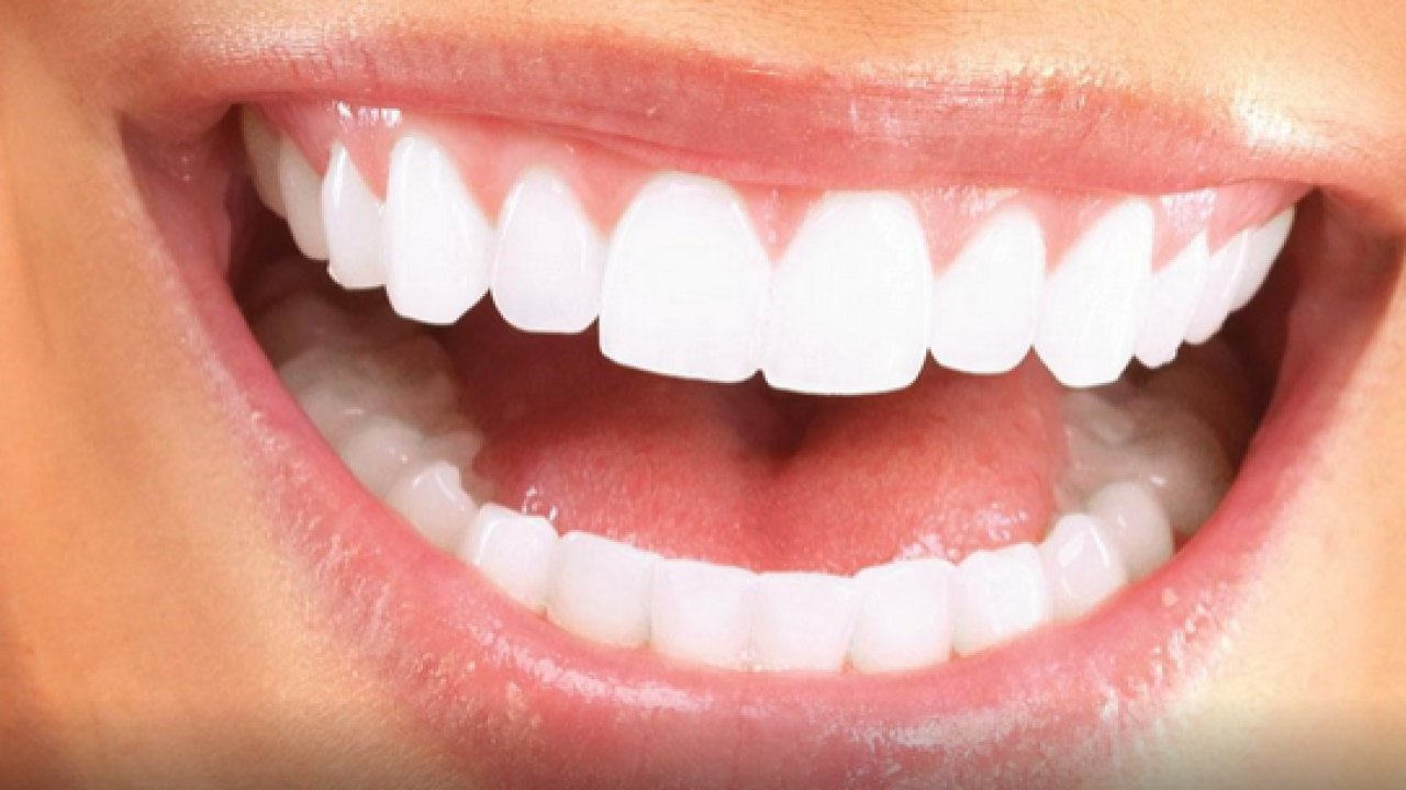 Lamine Diş Kaplama Nedir? Nasıl Yapılır?