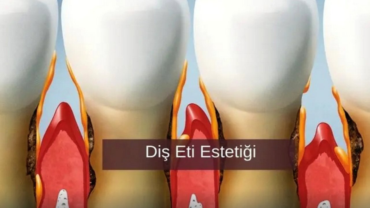 Diş Eti Estetiği