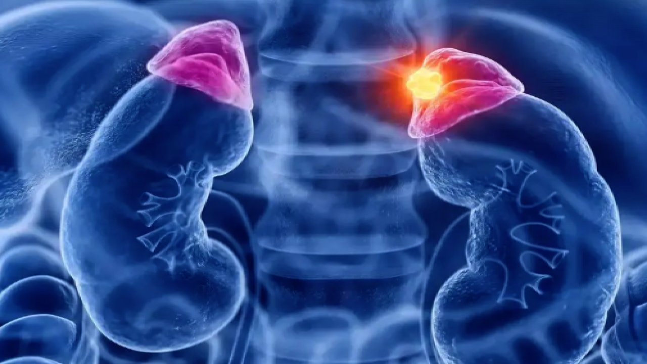 Böbreklerde Kist ve Tedavisi