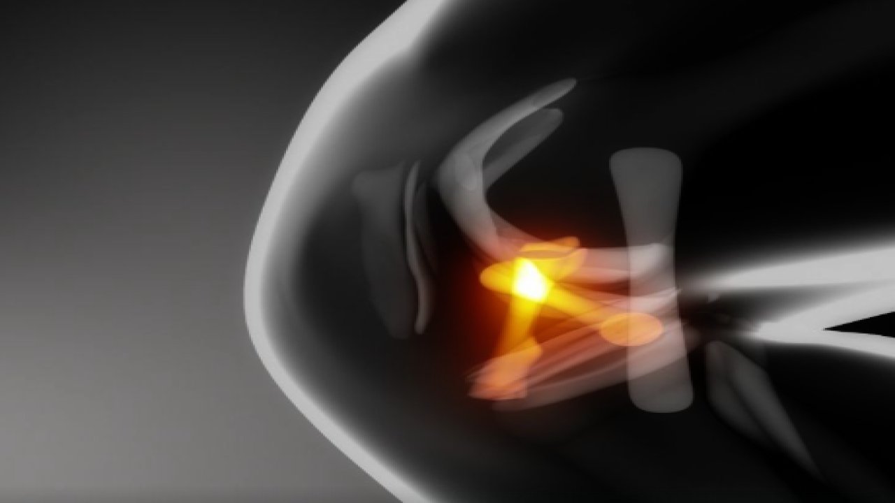 Ön Çapraz Bağ Ameliyatı: Modern Teknikler ve Spora Dönüş Süreci