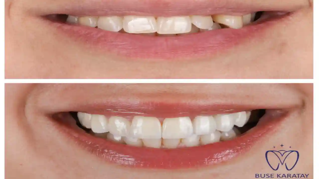 Gömülü Diş İhmal Edilmemeli