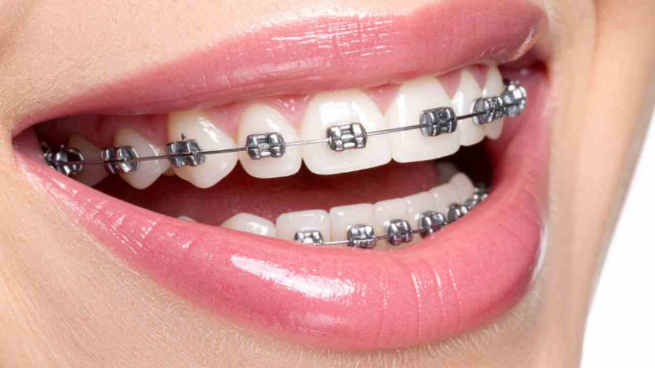 Diş Teli Fiyatları Ne Kadar?