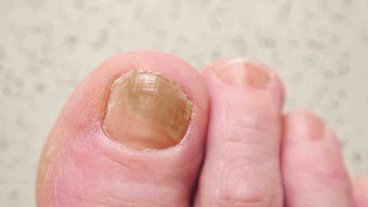 Tırnak Mantarı: Sadece Görsel Bir Sorun Değil, Bir Kurtulma Hikayesi