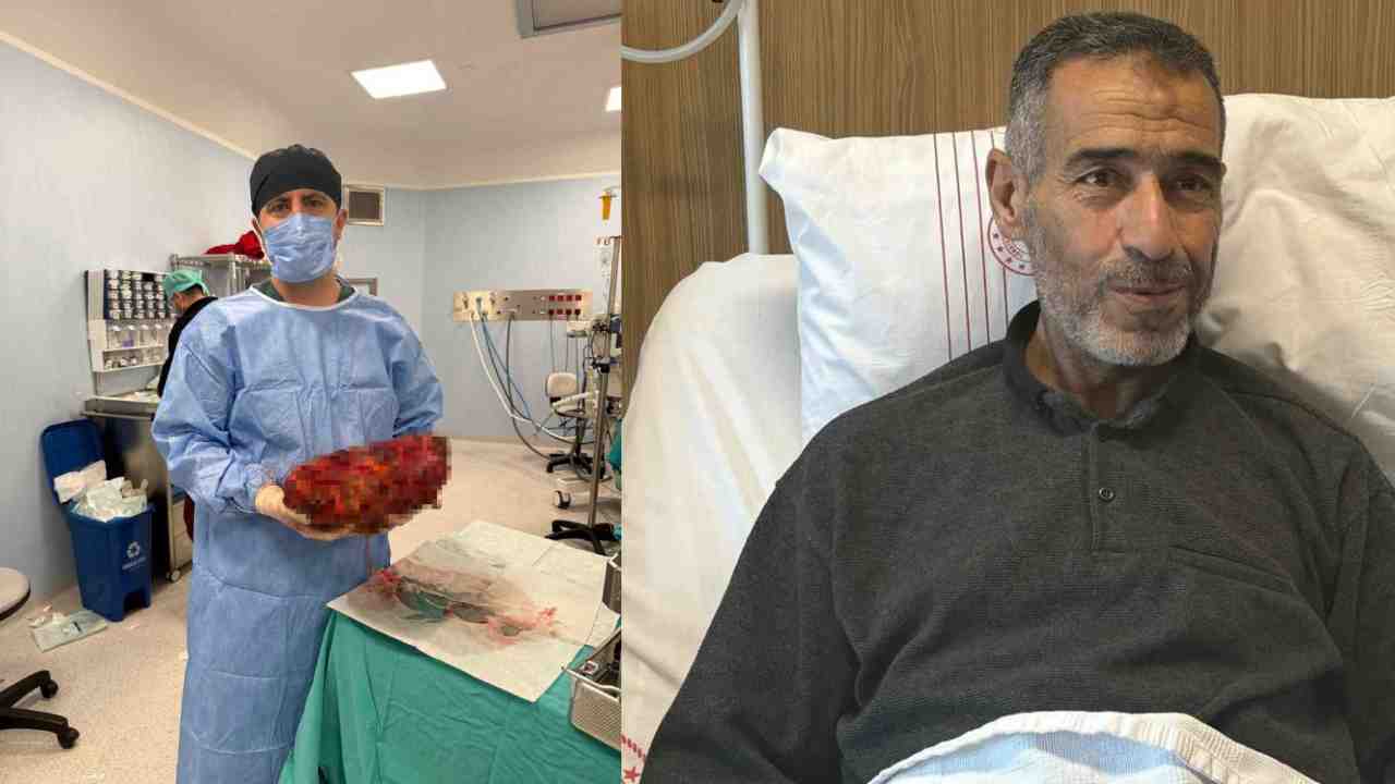 Gaziantep'te Tıp Dünyasını Şaşırtan Olay: Karnından 8 Kiloluk Dev Çıktı!