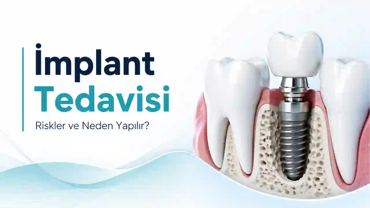 İmplant Tedavisi Tehlikeleri Var mı Neden Yapılır